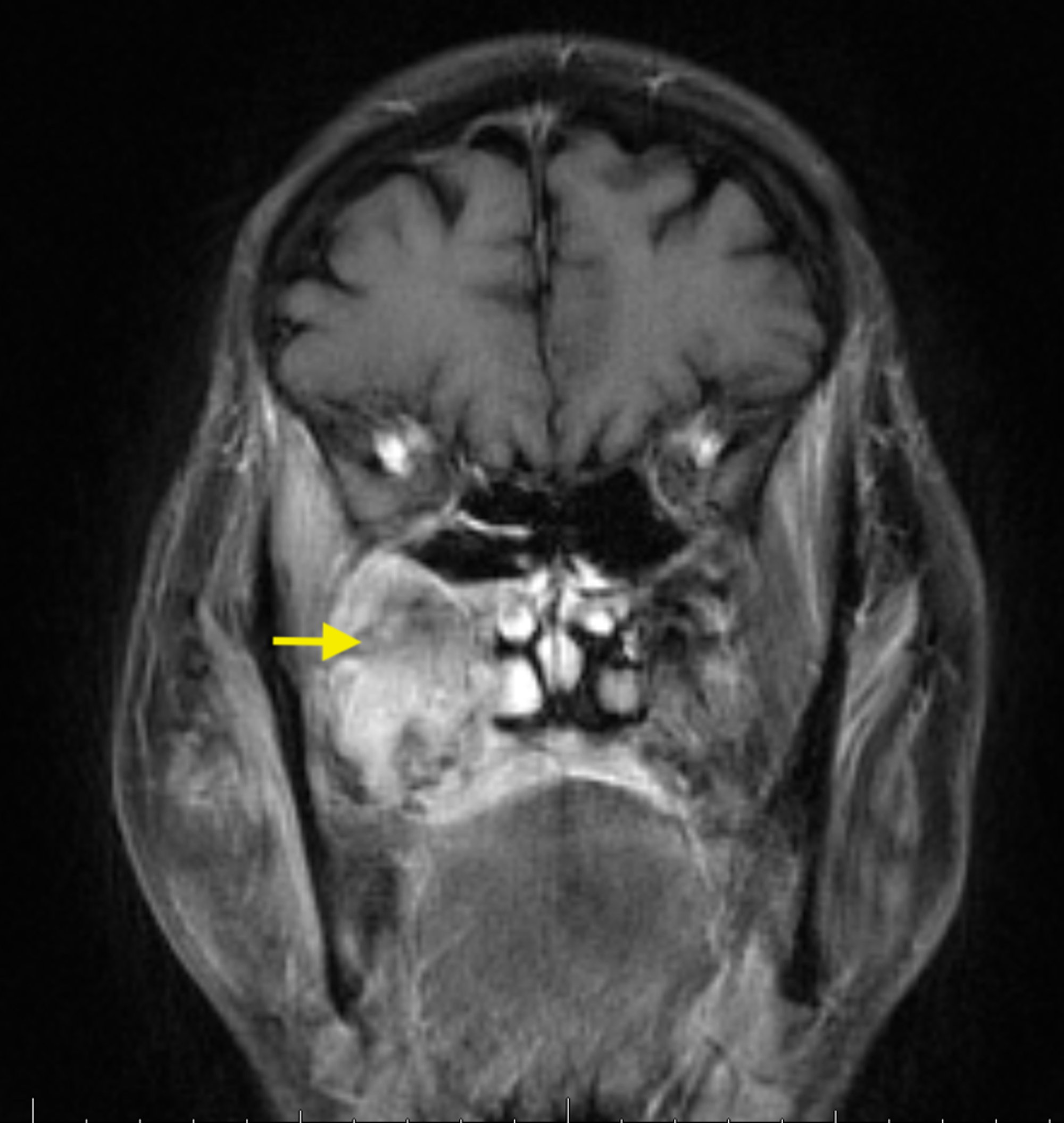 Cureus Maxillary Osteomyelitis with an Incidental Diagnosis of