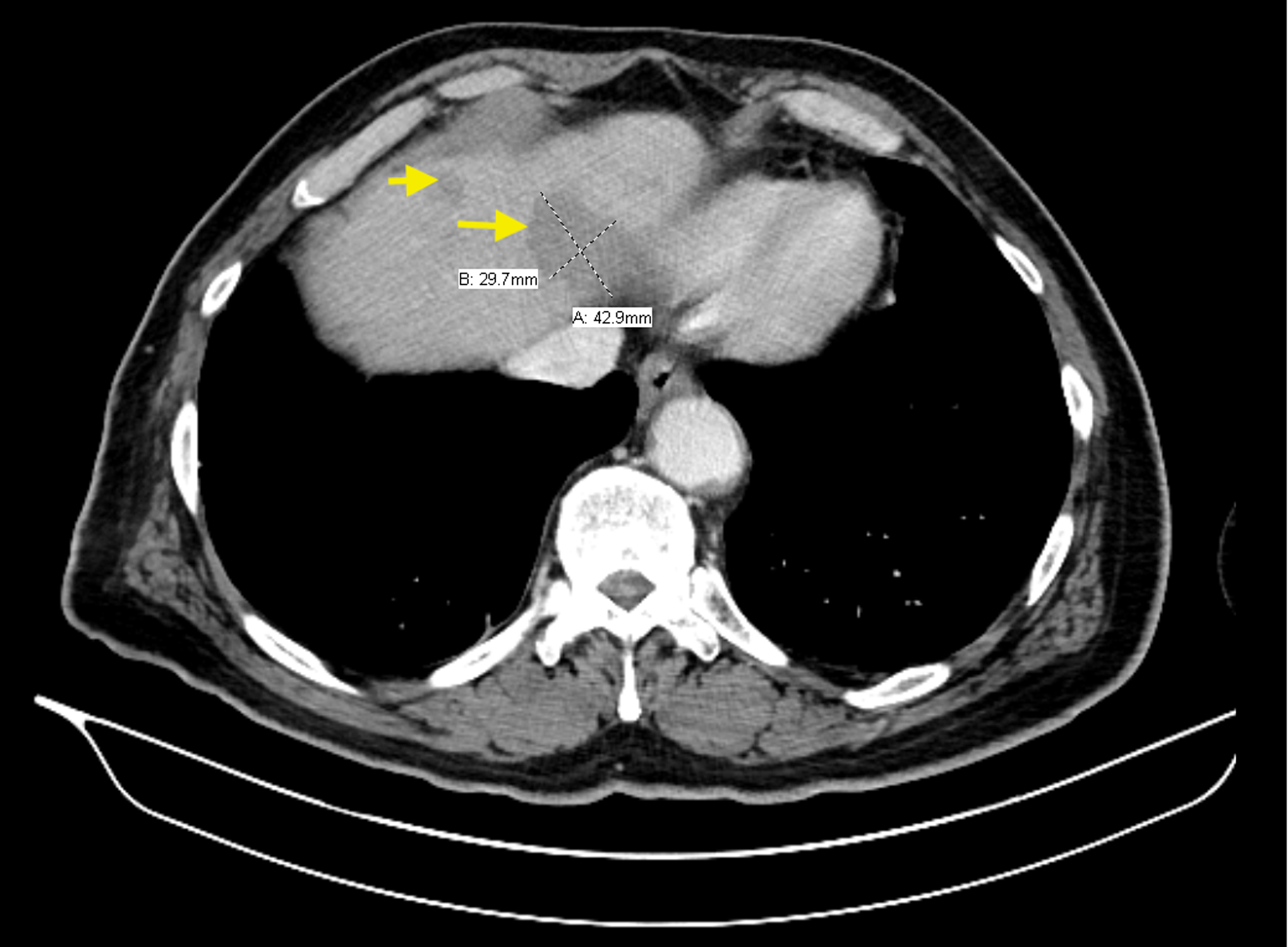 Cureus Maxillary Osteomyelitis with an Incidental Diagnosis of