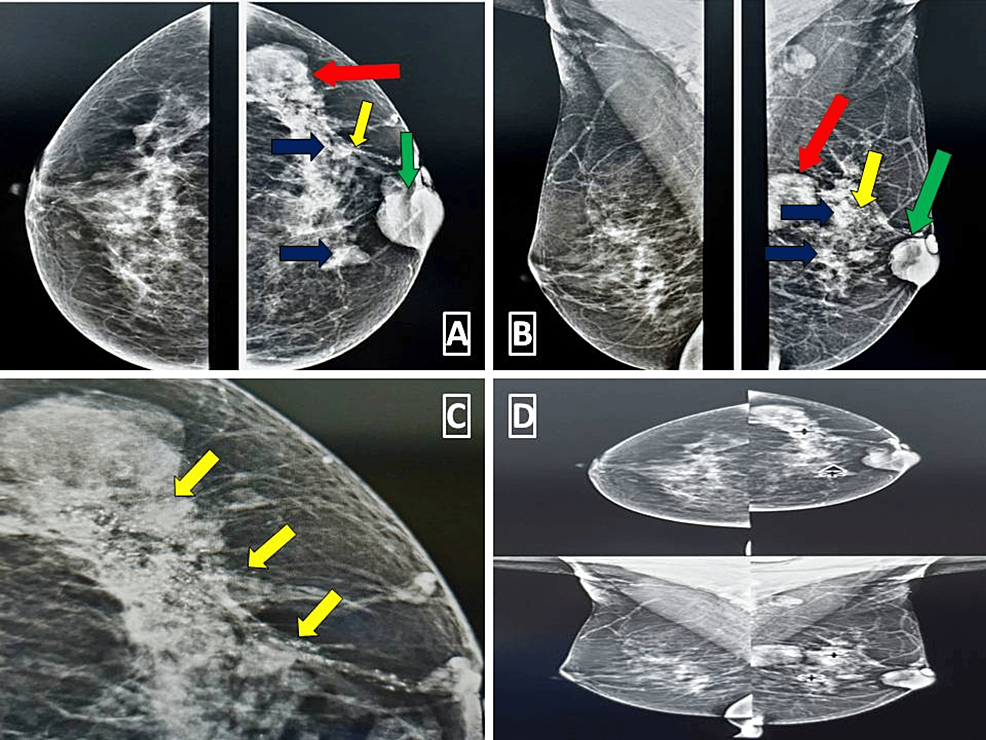 Cureus, Can Artificial Intelligence Beat Humans in Detecting Breast  Malignancy on Mammograms?