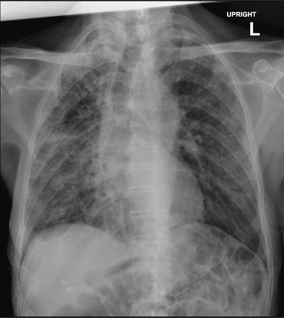 Cureus | An Unusual Association of Idiopathic Syndrome of Inappropriate ...