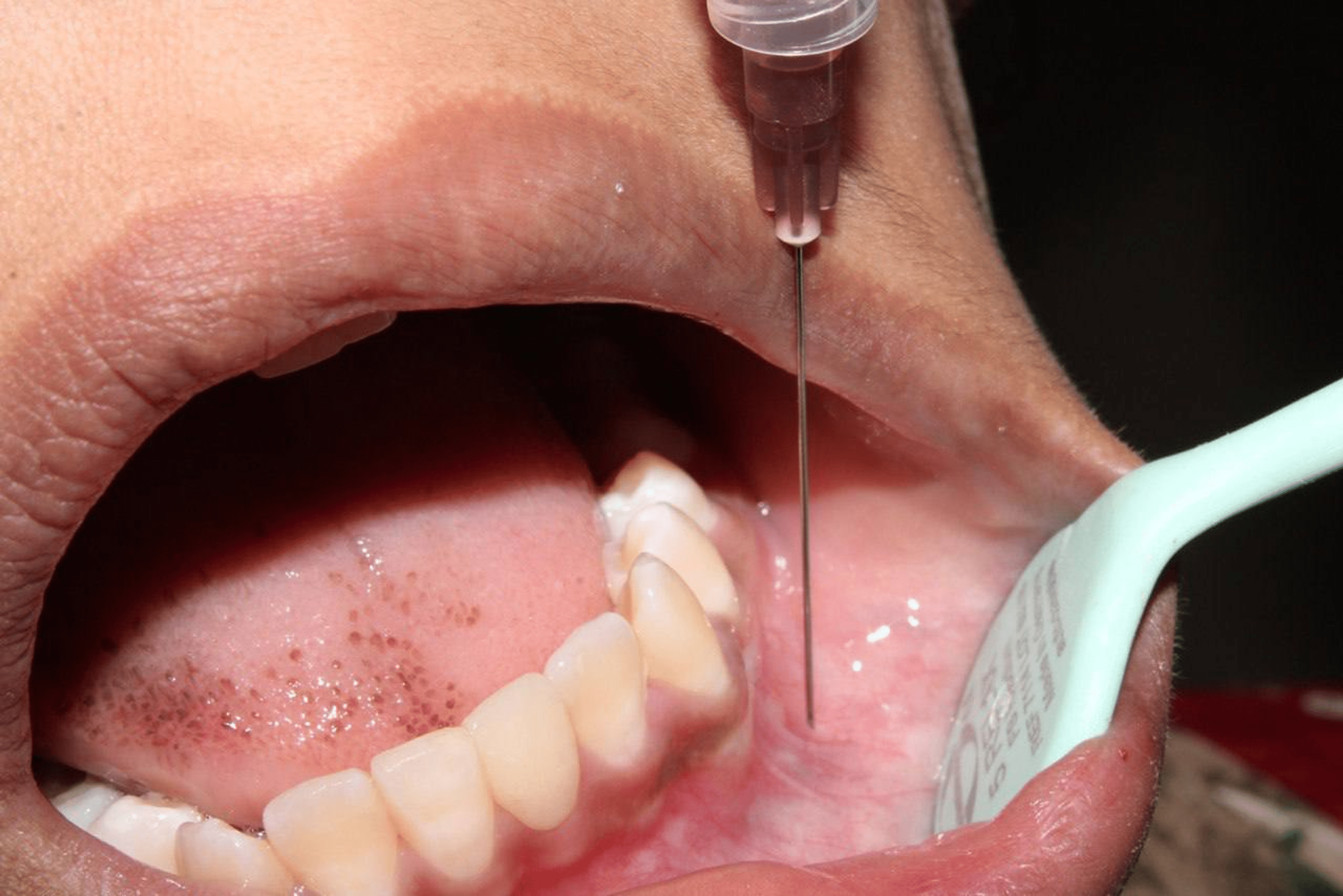 Comparison of Pain Perception Between Local Infiltration and Inferior