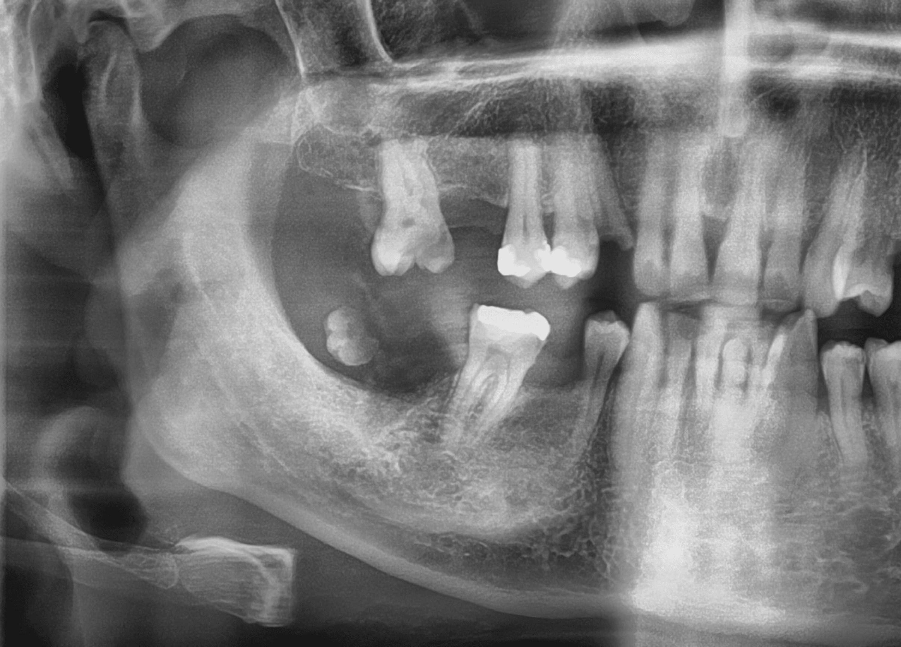 Prevalence and Radiographic Features of Head and Neck Soft Tissue