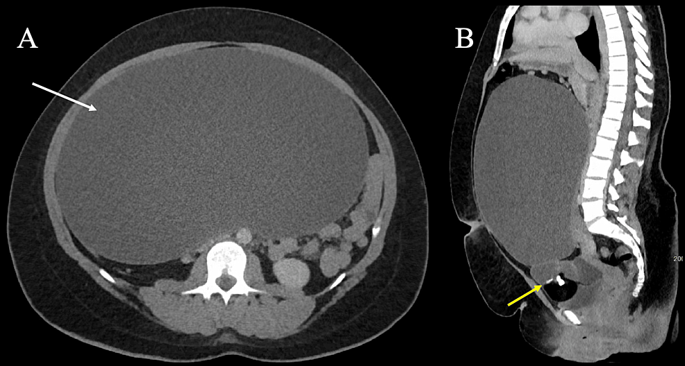 Ruptured ovarian cyst, Radiology Reference Article