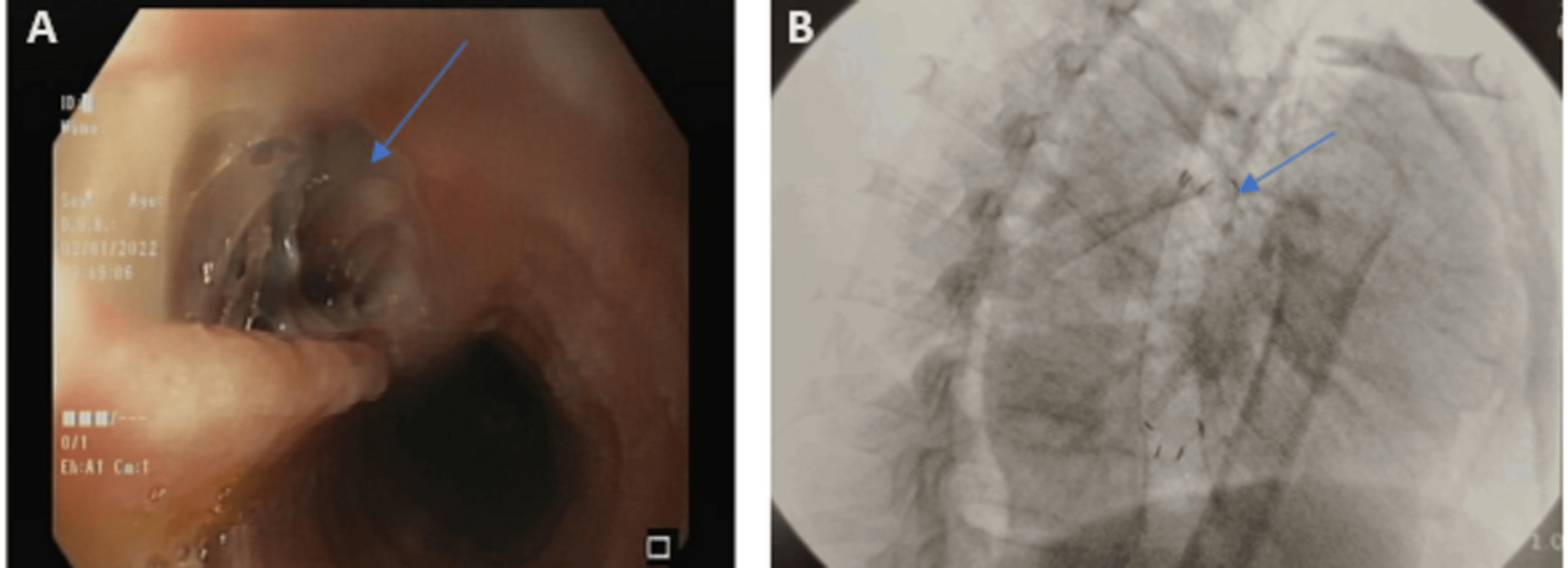 Cureus Spontaneous Endoscopic Esophageal Stent Fracture Post