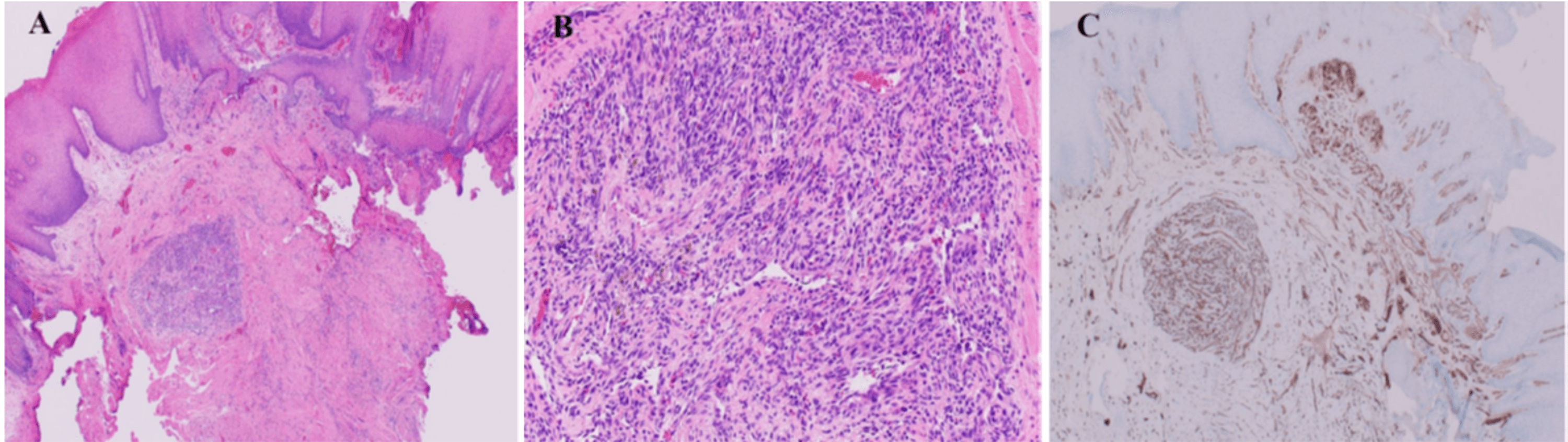 Cureus The Use of Diode Laser for the Surgical Removal of Pyogenic