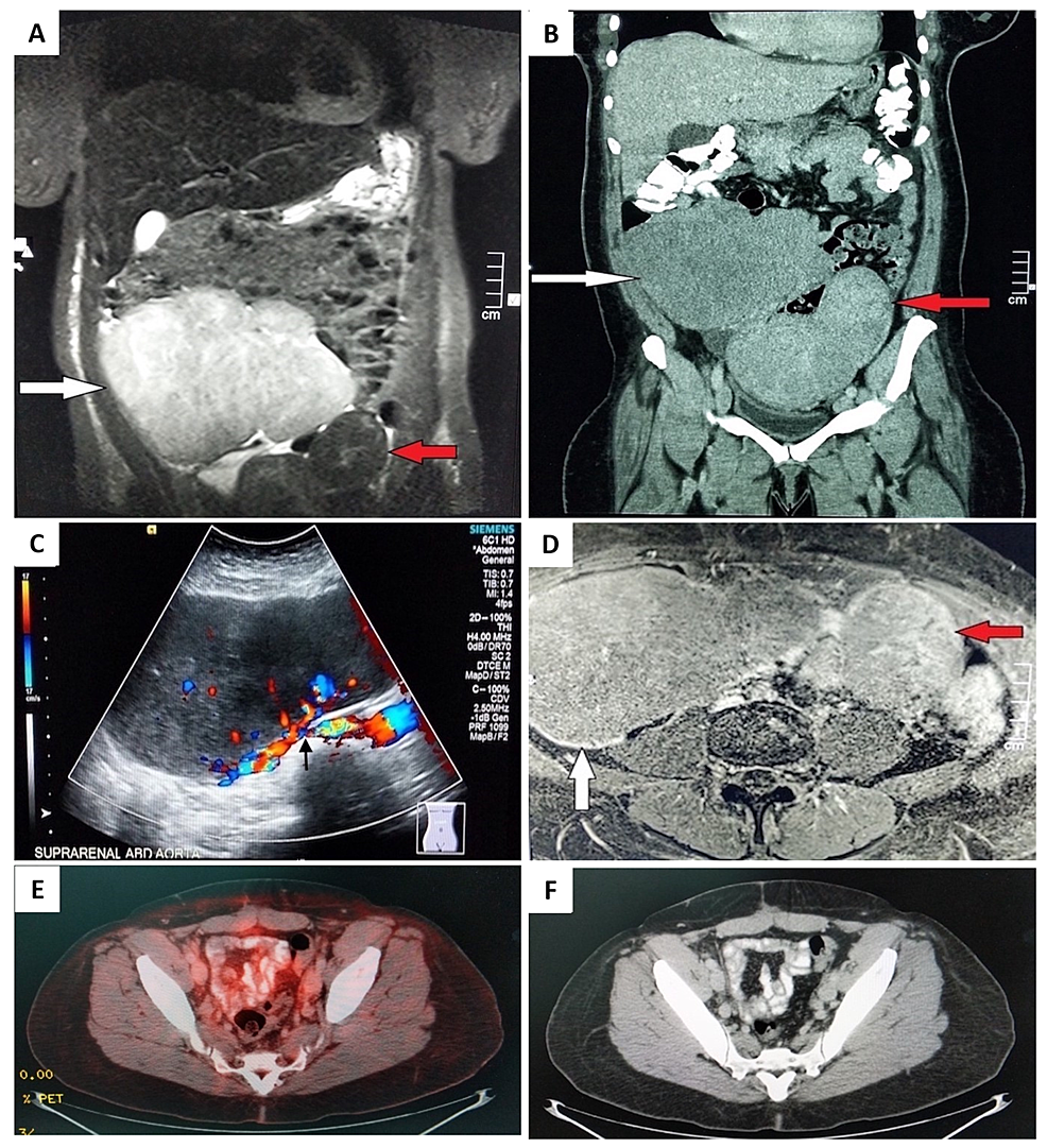 Radiology-images-at-the-time-of-presentation.-A-coronal-T2W-MRI-(A)-and-coronal-CT-(B)-images-demonstrating-an-exophytic-mass-(red-arrow)-arising-from-the-uterus-(leiomyoma)-and-a-large-tumor-mass-(white-arrow)-with-high-signal-intensity-on-MRI.-A-trans-abdominal-ultrasound-(C)-demonstrating-a-large-tumor-mass-with-increased-vascularity-(arrow).-An-axial-T2W-MRI-image-(D)-showing-a-large-tumor-mass-(white-arrow)-and-left-tumor-mass-(red-arrow).-Post-therapeutic-radiology-images-(E,-F):-A-PET/CT-image-(E)-showing-no-evidence-of-hypermetabolic-activity.-An-axial-CT-of-the-pelvis-(F)-showing-the-post-surgical-empty-space-in-the-center-of-the-pelvis-occupied-by-the-bowel-with-no-evidence-of-malignancy.-Abbreviations:-T2W,-T2-weighted;-PET,-positron-emission-tomography.