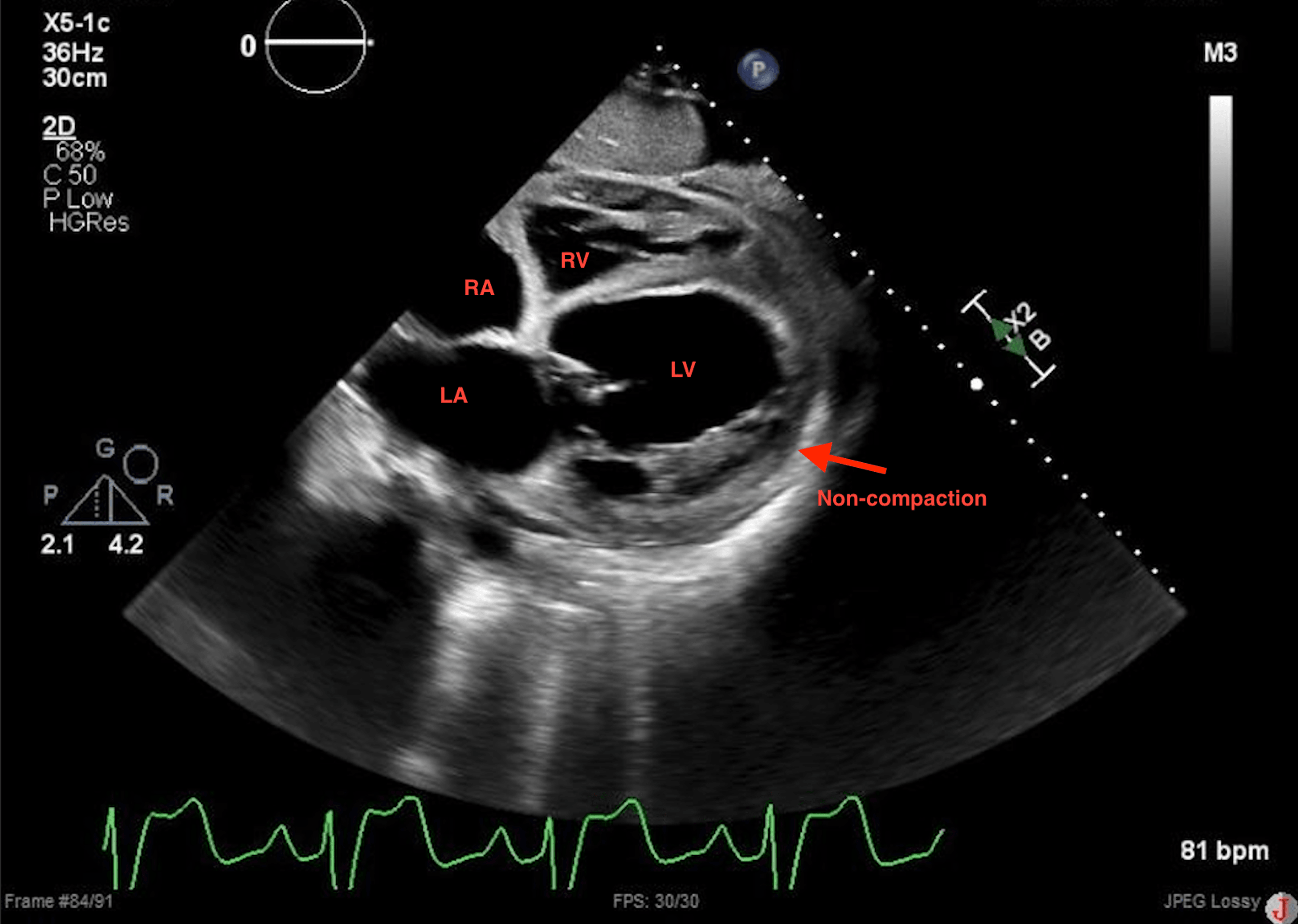 Cureus Left Ventricular Cardiomyopathy The Key to Its