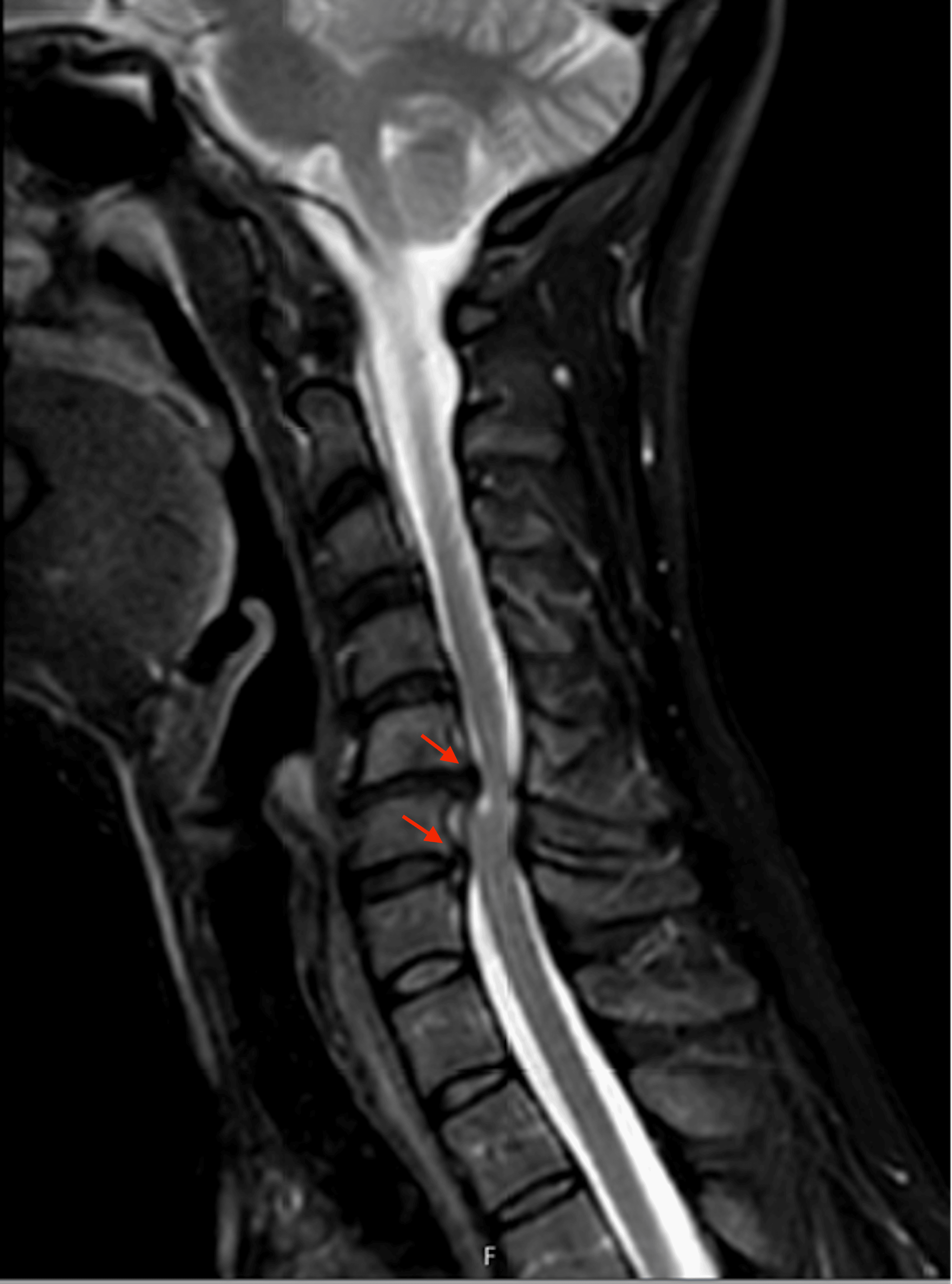 Cureus | Deep Brain Stimulation Before Anterior Cervical Discectomy And ...