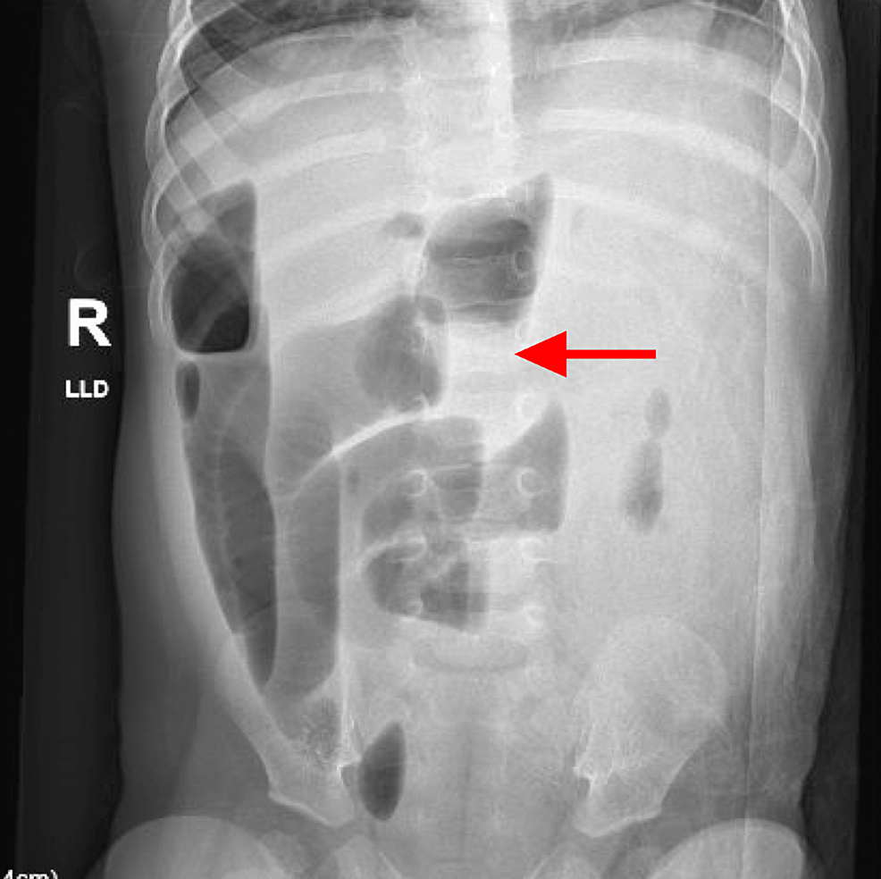 X-ray-of-the-abdomen:-AP-view