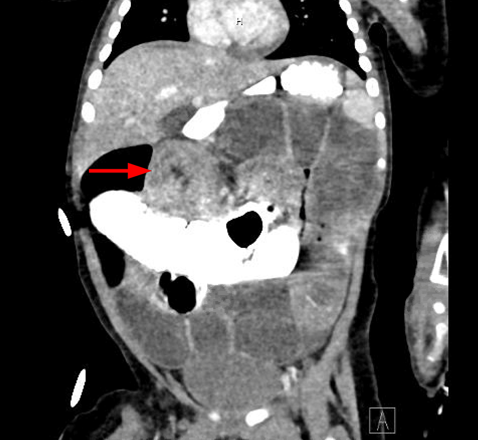 CT-of-the-abdomen-with-contrast