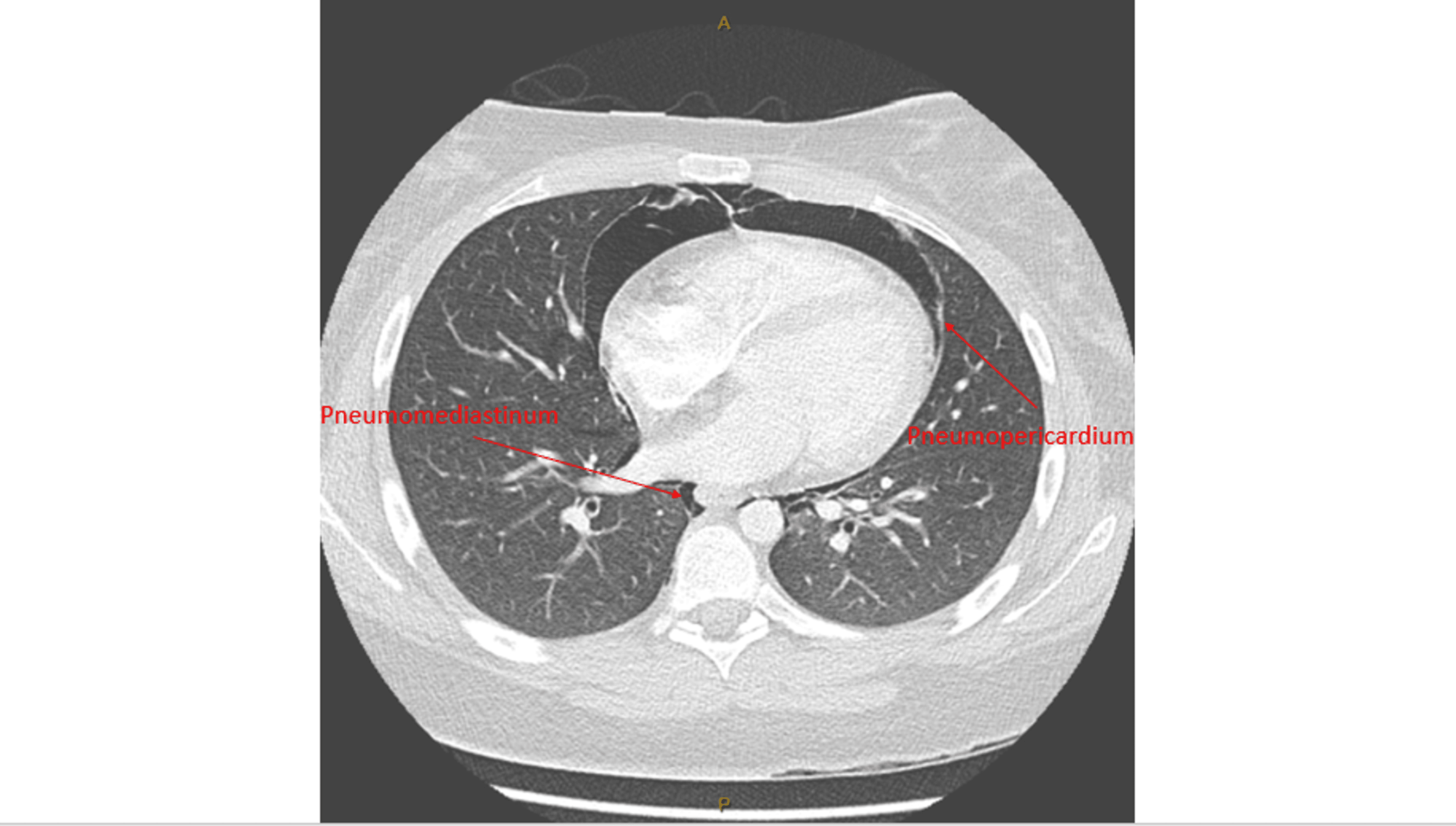 Cureus | Pneumomediastinum and Pericardium During Labour: A Report on a ...