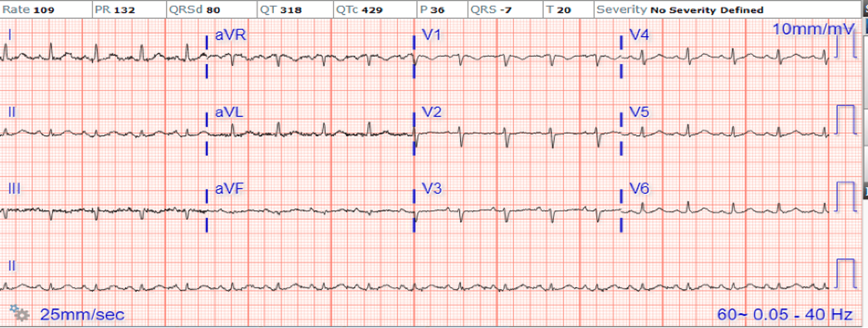 Cureus Progressively Prolonged PR Interval and Aortic Abscess