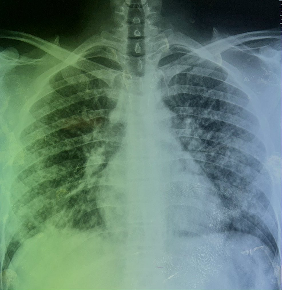 Posteroanterior-chest-radiograph-demonstrates-signs-suggestive-of-miliary-tuberculosis