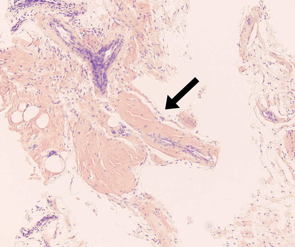 The Importance of UltrasoundGuided Synovial Biopsy in the Workup of