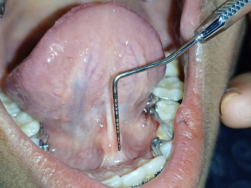 Management of TongueTie Using Diode Laser for Speech Clarity A Case