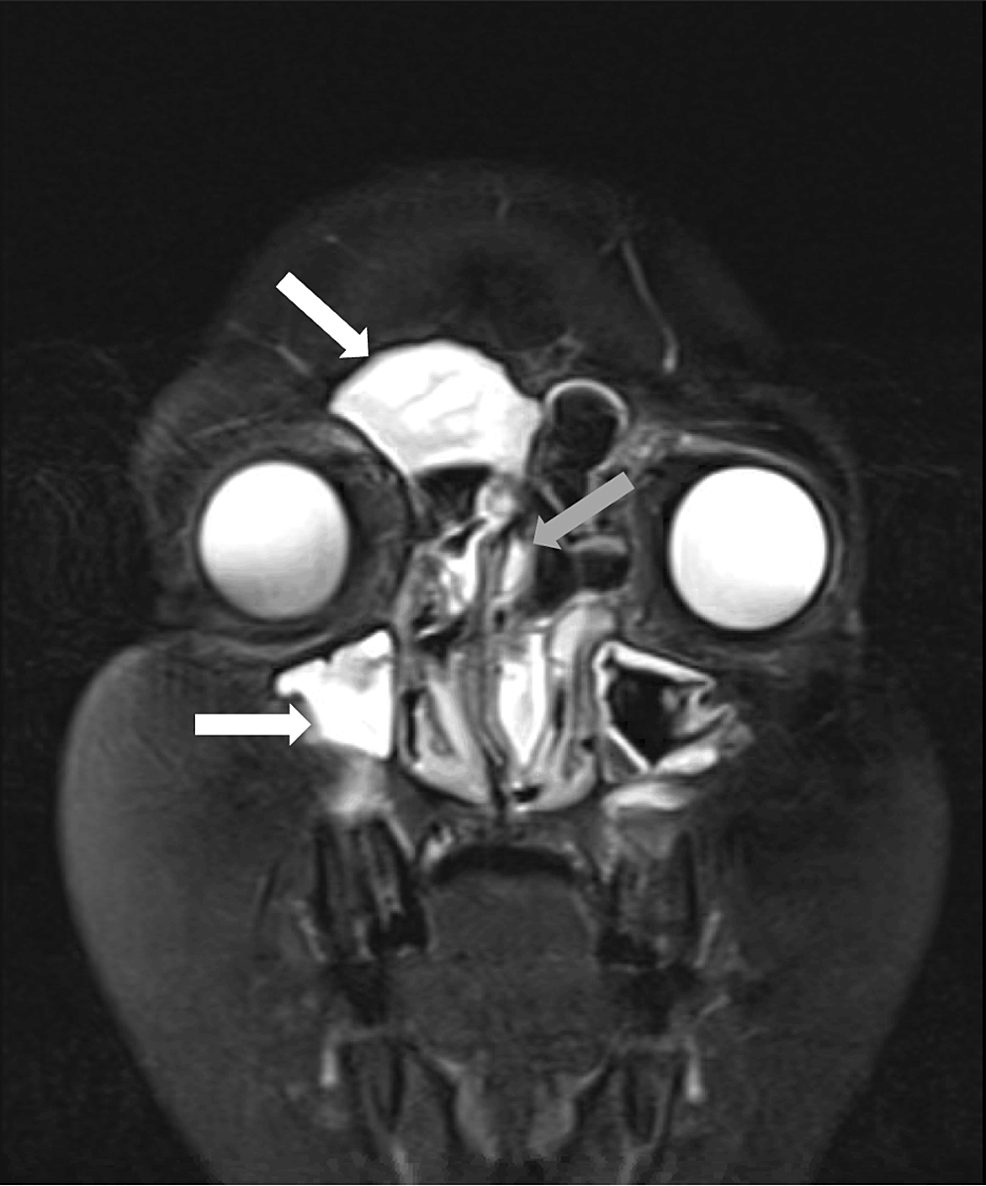 cureus-allergic-fungal-rhinosinusitis-in-a-12-year-old-male-resulting