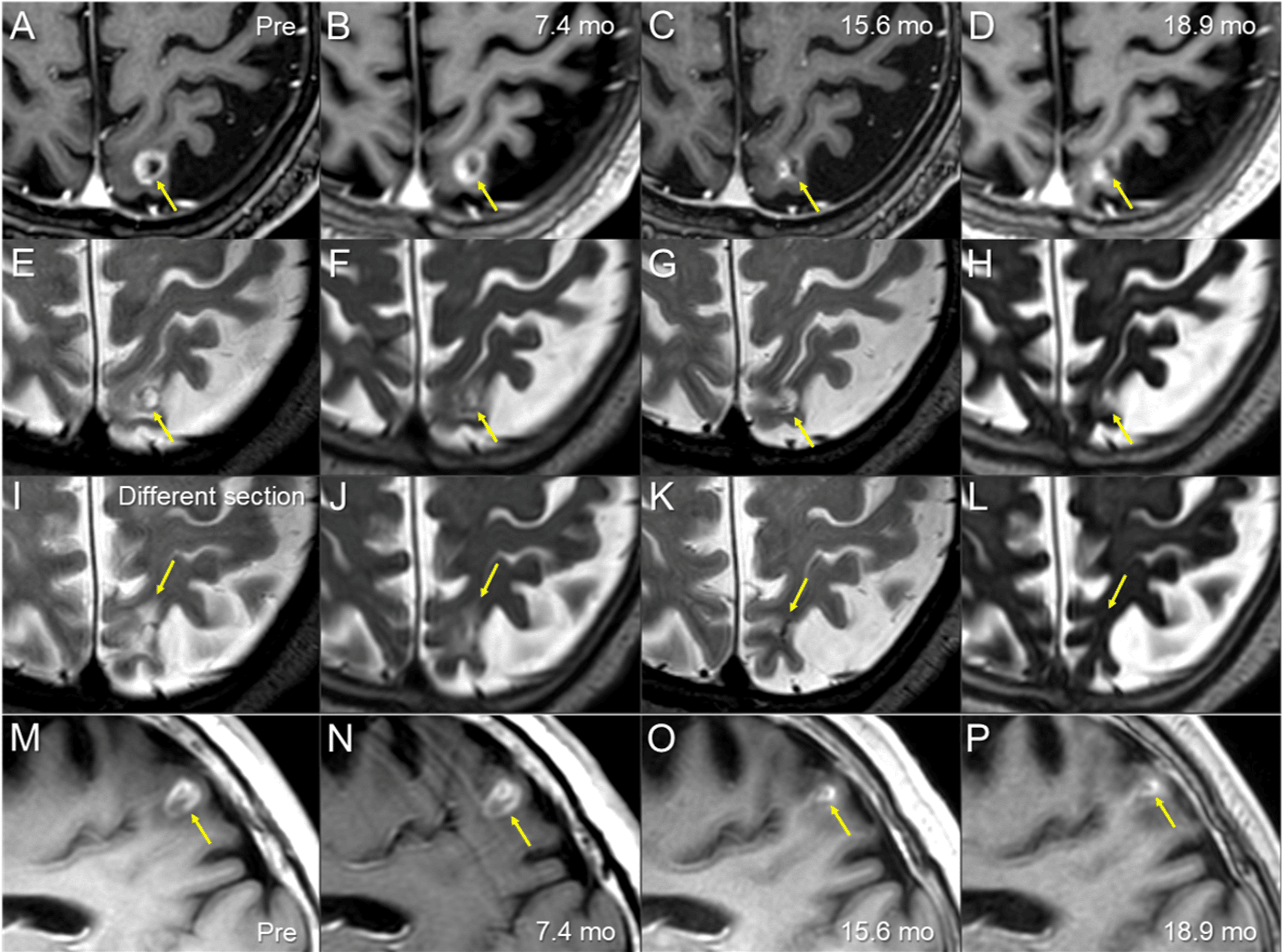 Cureus Immunity to Adverse Radiation Effects Following