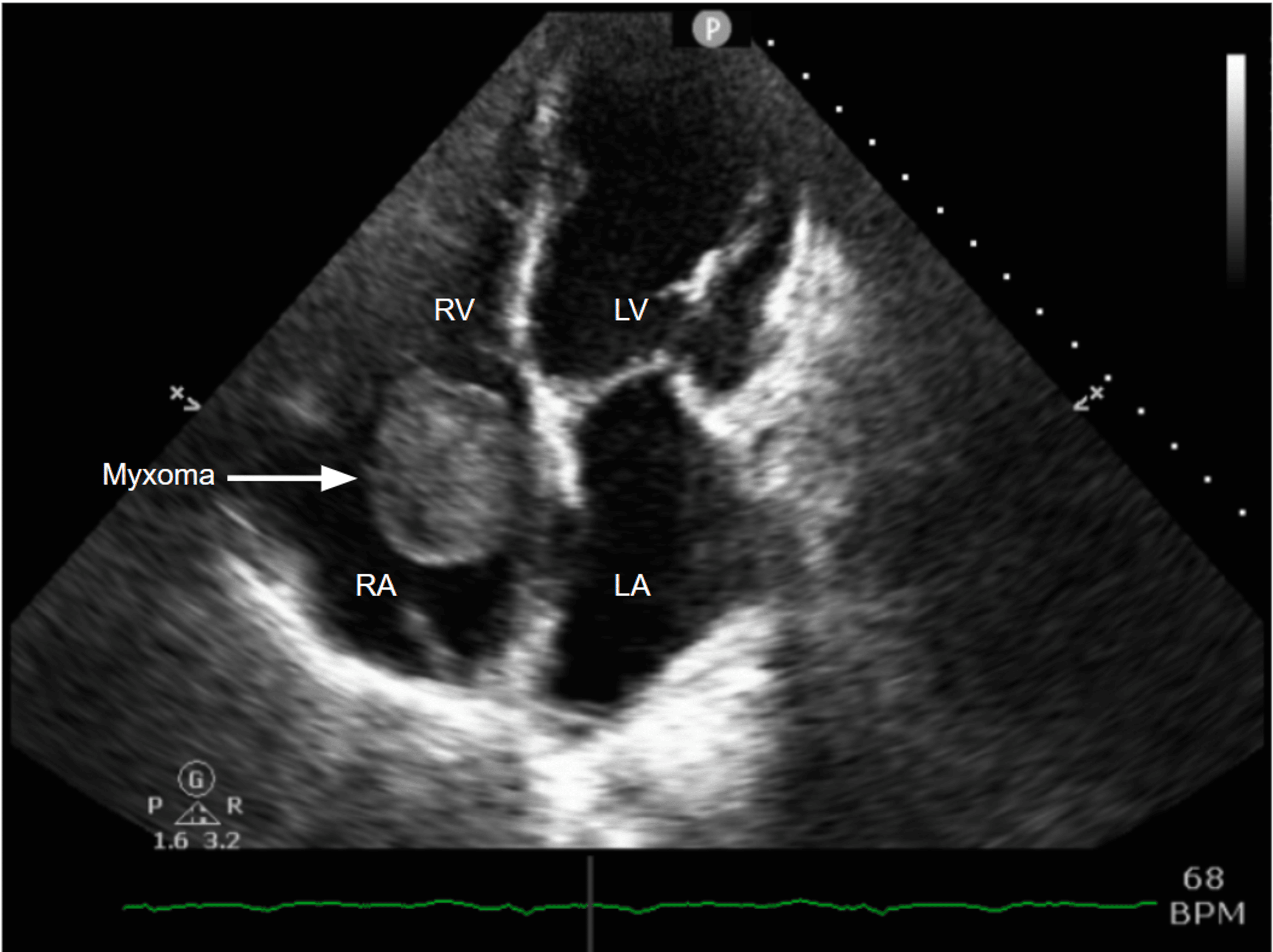 Large Right Atrial Myxoma: A Rare Presentation 