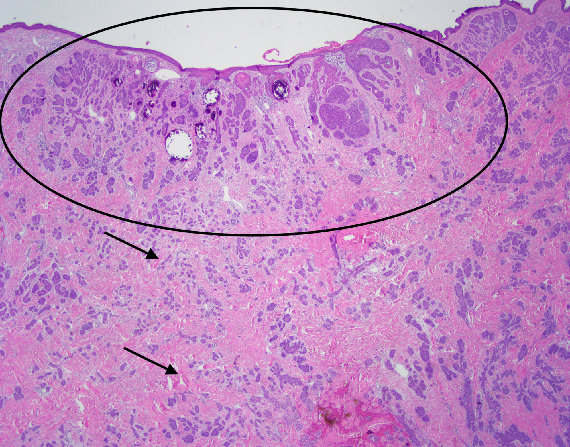 Cureus A Rare Presentation Of Basal Cell Carcinoma Arising
