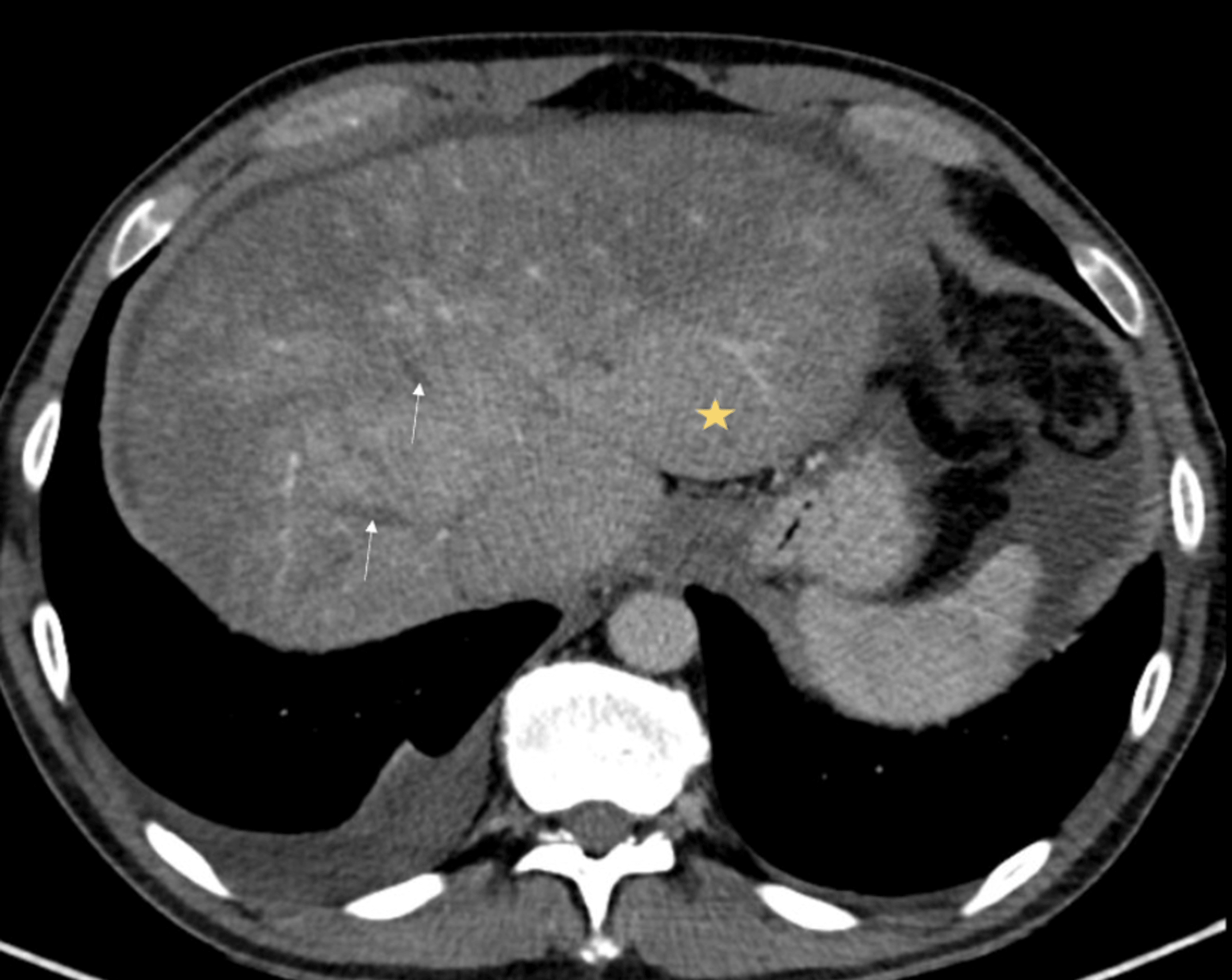 Cureus BuddChiari Syndrome Caused by Polycythemia Vera A Case Report
