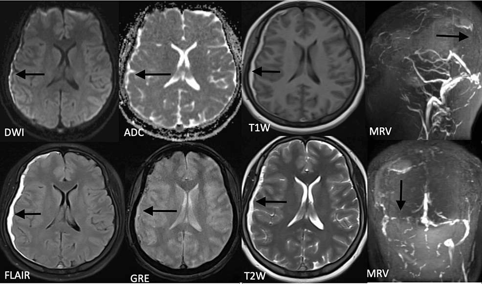 cortical vein thrombosis