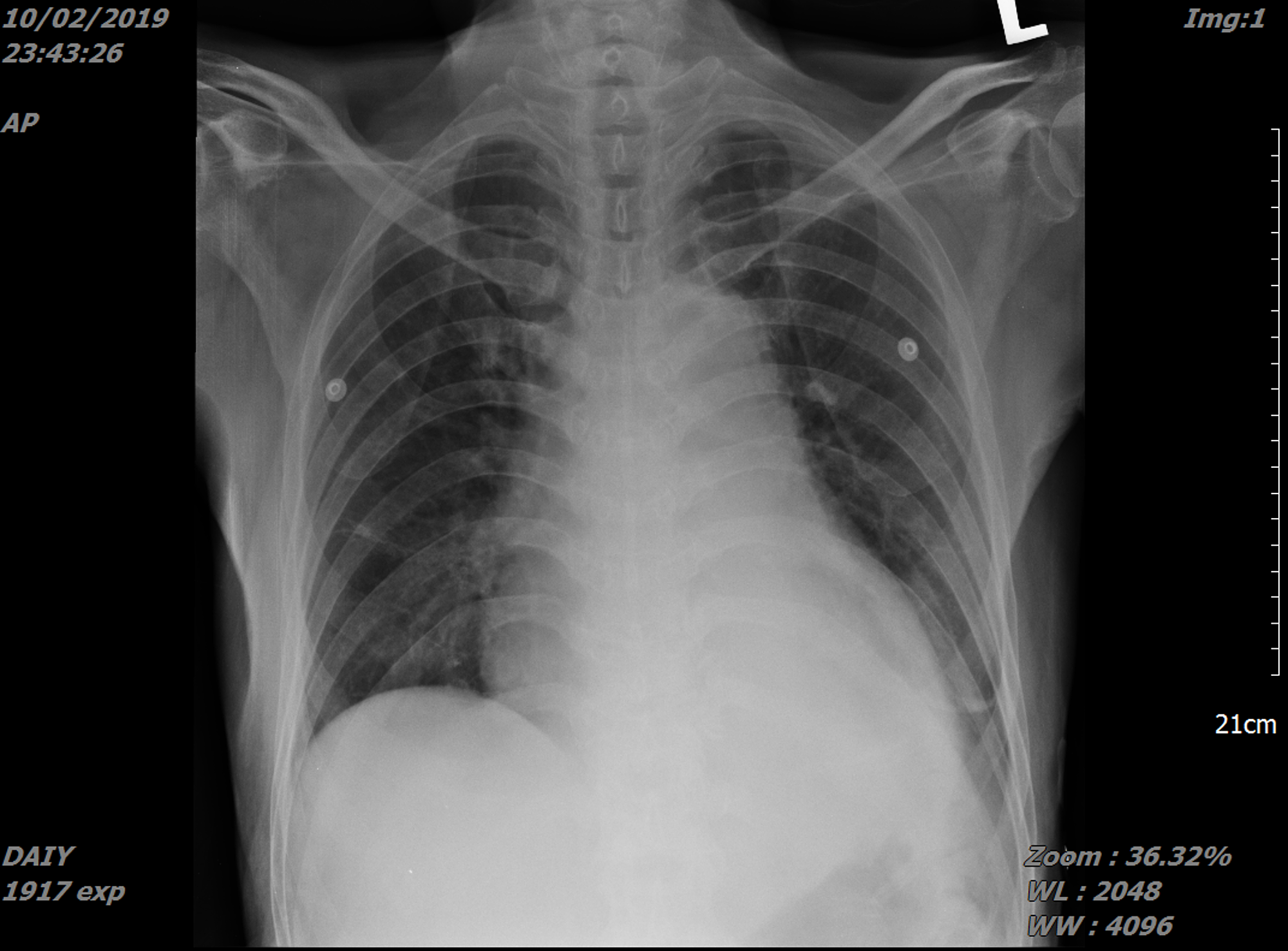 Cureus | A Rare Case of Purulent Pericardial TB