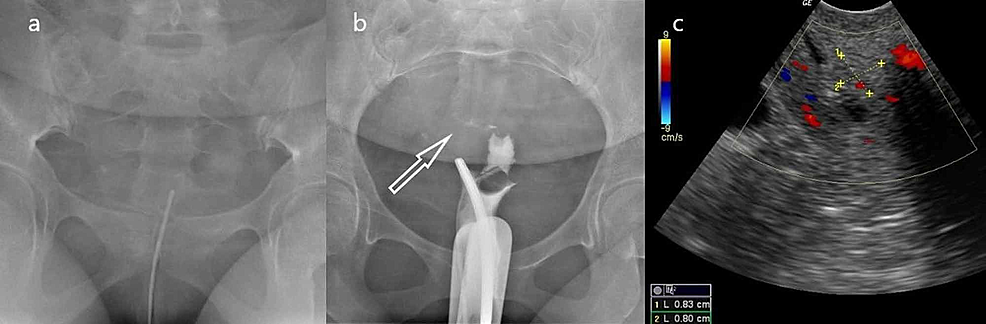 Obstructive Endometrial Polyp: A Case Report | Cureus