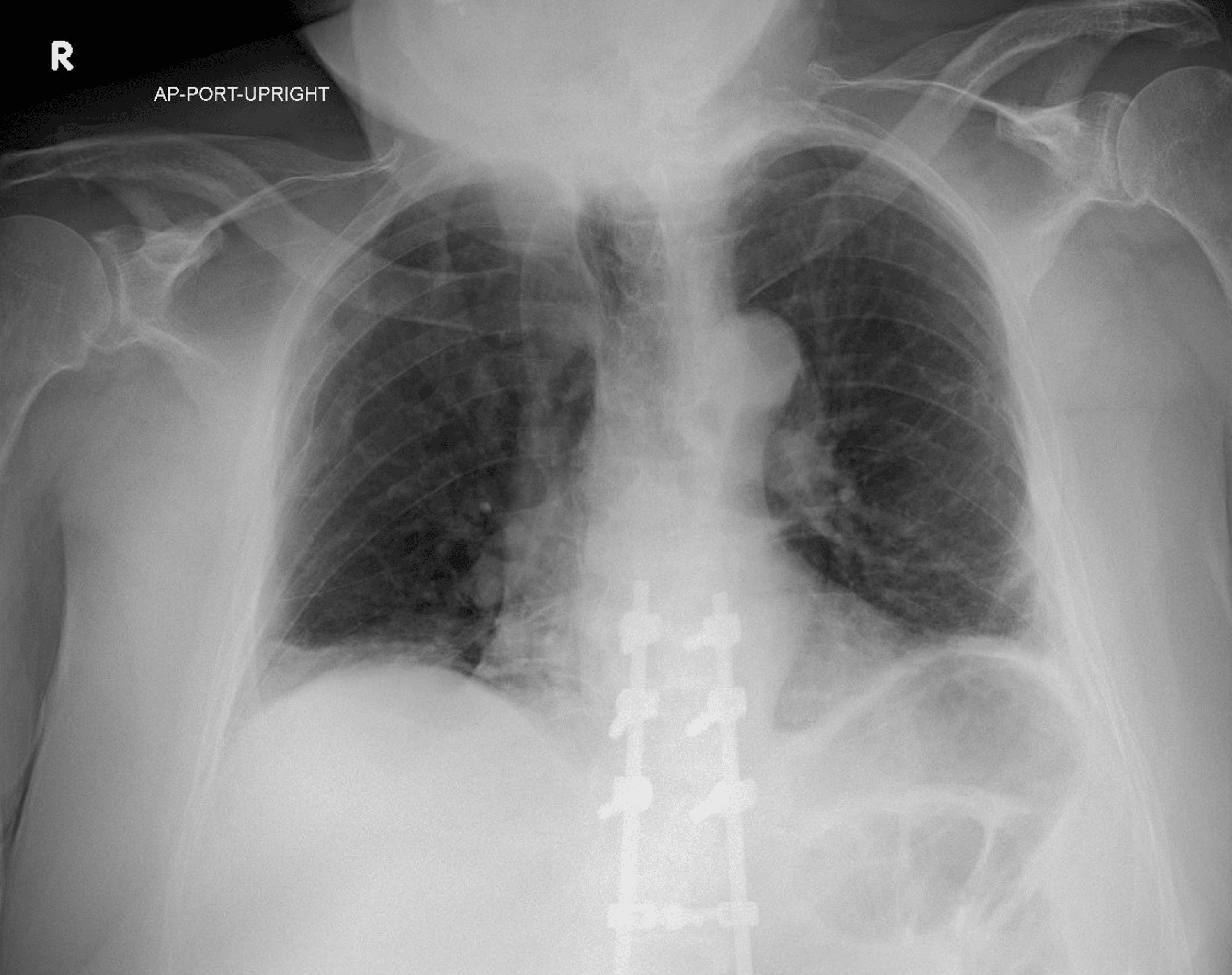 Cureus Symptoms of Myasthenia Gravis Obscured by Old Age and