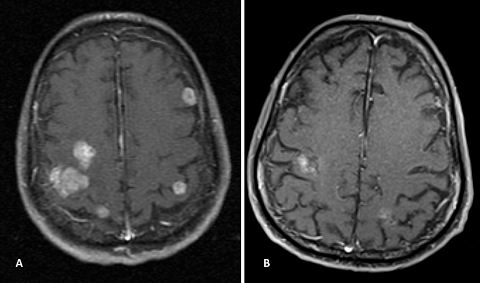 Cureus HIVassociated Nonsmallcell Lung Cancer with Rearrangement