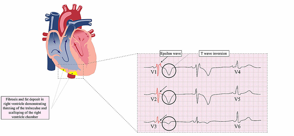 Cureus | Arrhythmogenic Right Ventricular Cardiomyopathy/Dysplasia: An ...