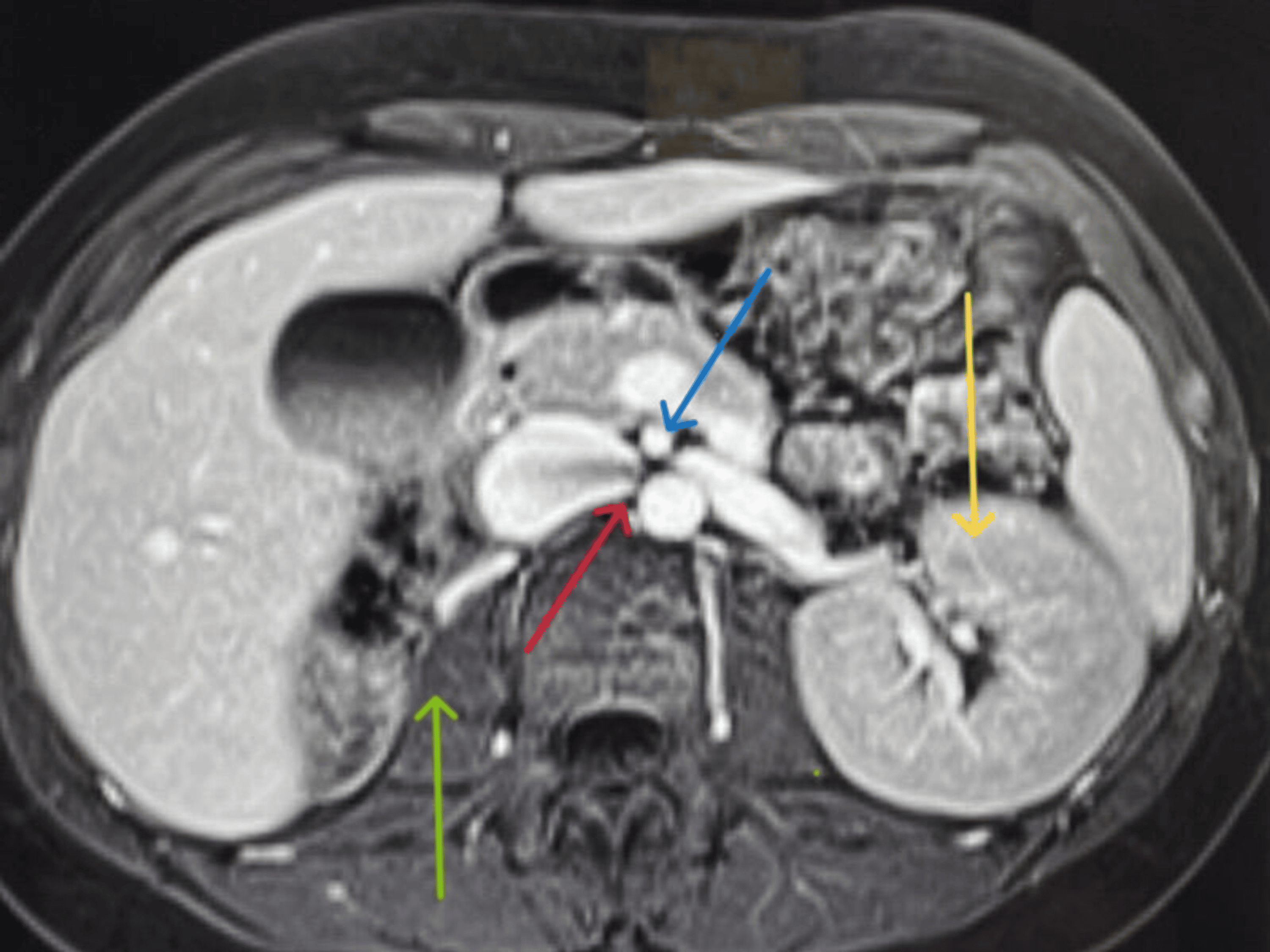 A Rare Case of Nutcracker Phenomenon Associated With Midgut Malrotation