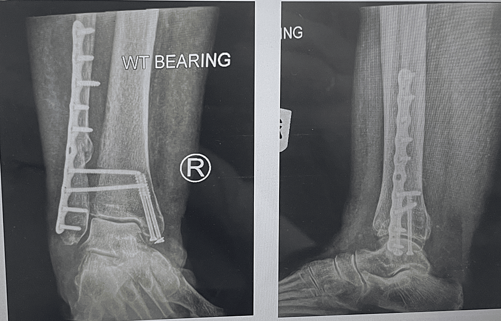 Radiographic Evaluation Of Syndesmosis Stabilisation Using The ...