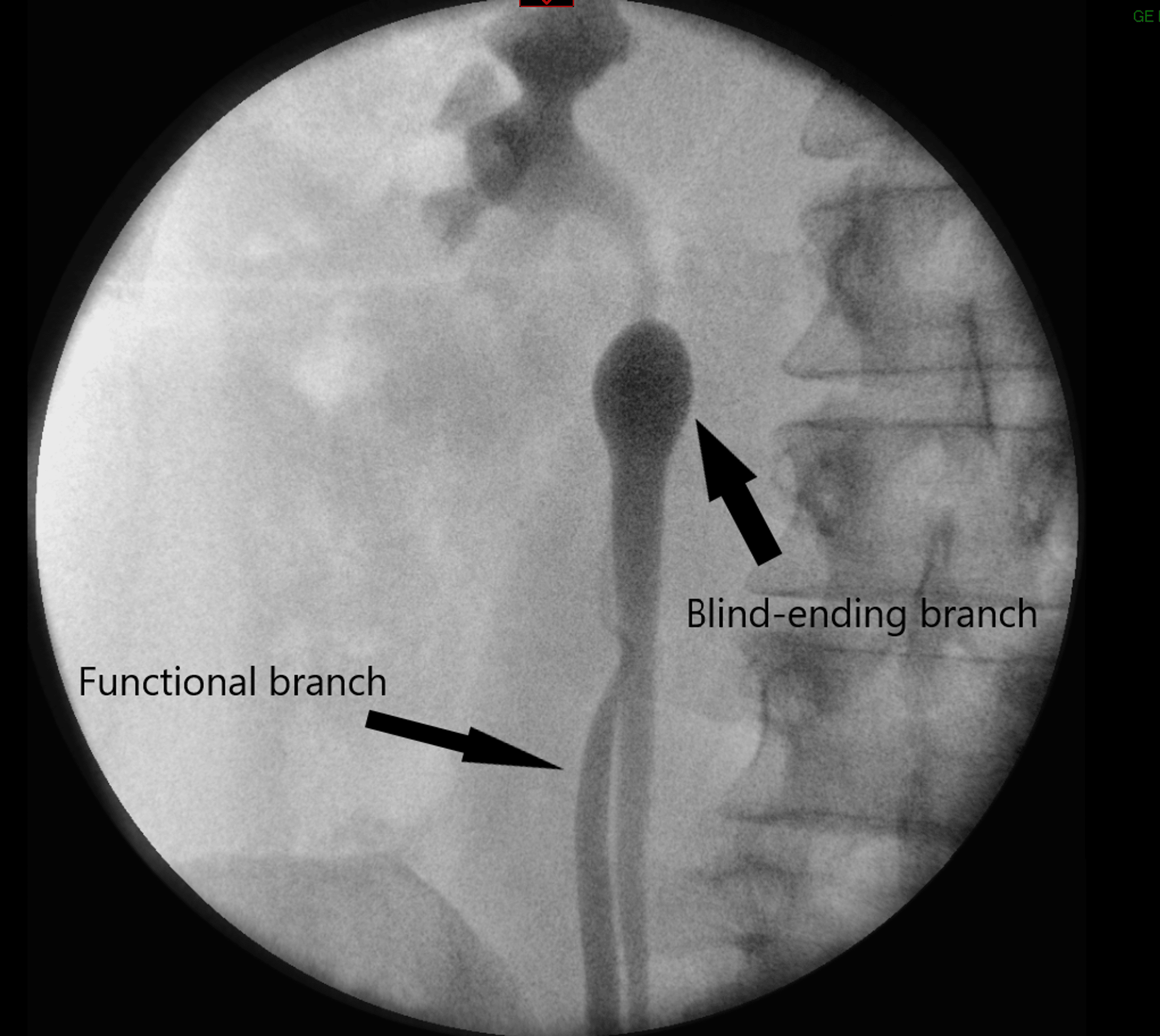 Yo Yo Reflux Into A Blind Ending Branch Of A Bifid Ureter A Case