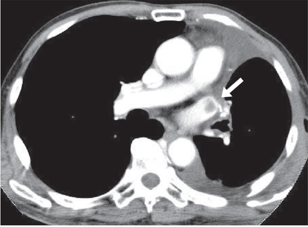 CT-scan-of-the-chest-with-IV-contrast
