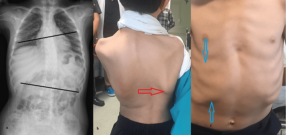 Cobb's angle (*) measurement in scoliosis. (A) Before application of