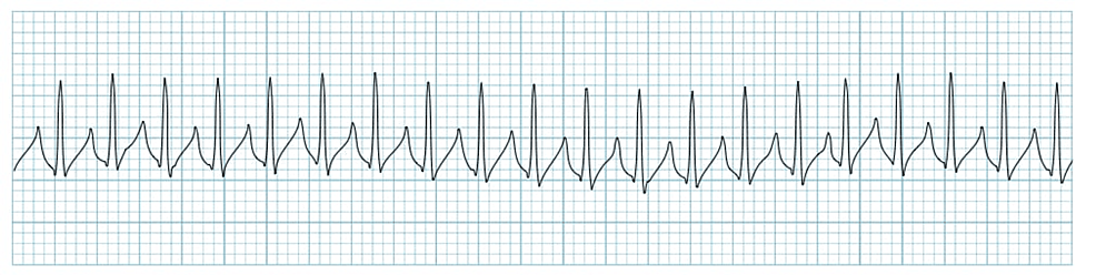 Efficacy Of Adenosine Versus Verapamil In Terminating Acute Attacks Of ...