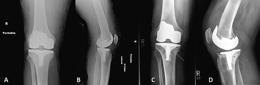 Elusive Differential Of A Painful Unstable Total Knee Arthroplasty ...