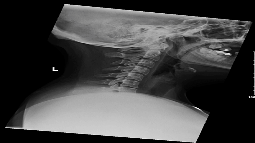 COVID-19 Vaccines and Axillary Nerve Dysfunction: A Case Report