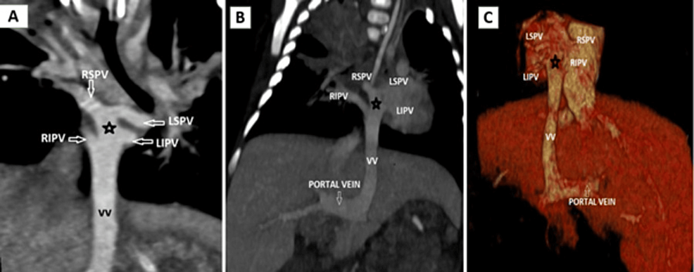 Cureus Multidetector Computed Tomography Mdct Angiography