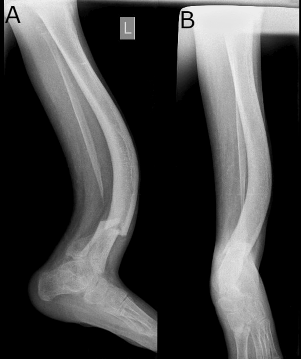 Llizarov Tibia Ring External Fixator Lengthening for Delayed