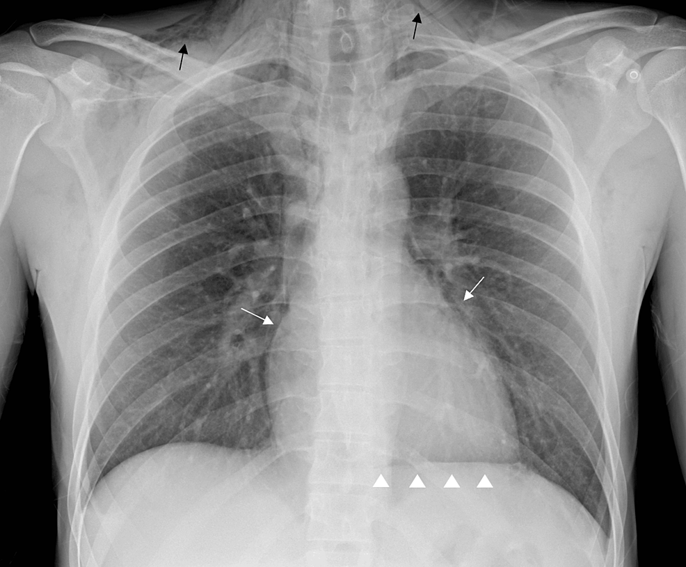 Cureus Spontaneous Pneumomediastinum A Rare Cause Of Chest Pain