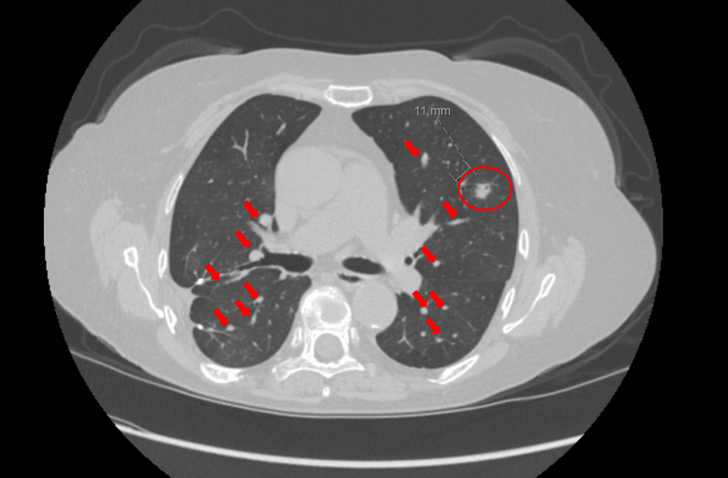 Cureus | Diffuse Idiopathic Pulmonary Neuroendocrine Cell Hyperplasia ...