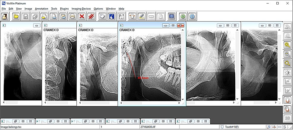 Cureus, A New Approach for Explaining and Treating Dry Sockets: A Pilot  Retrospective Study