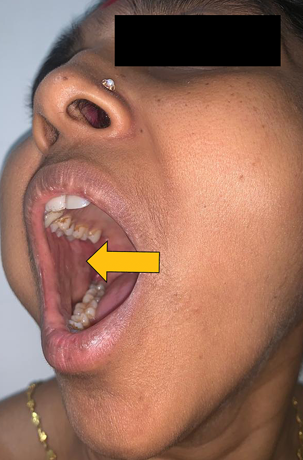 cureus-pleomorphic-adenoma-of-the-cheek-a-case-report