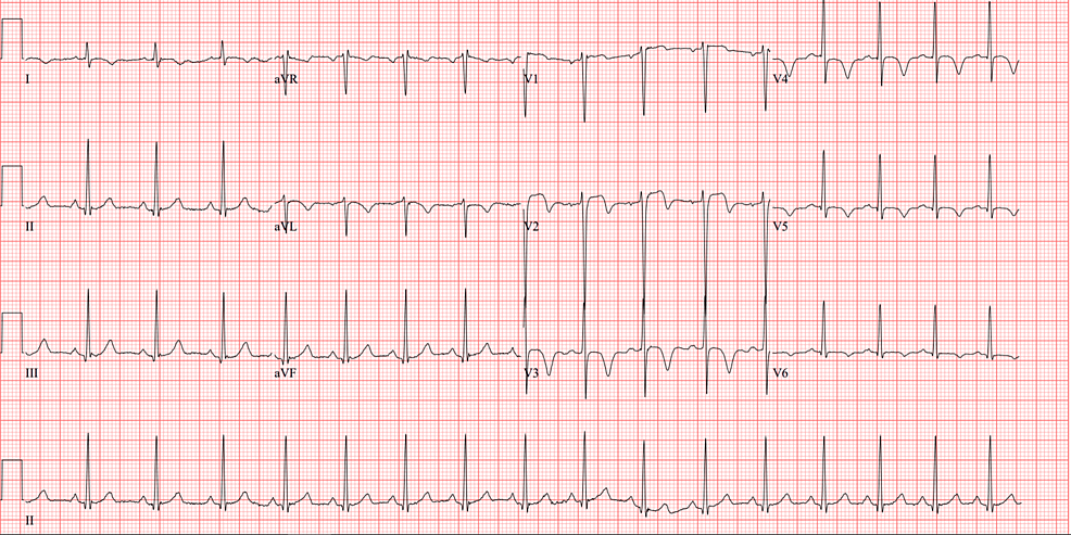 Cureus | A Case of Wellens' Syndrome