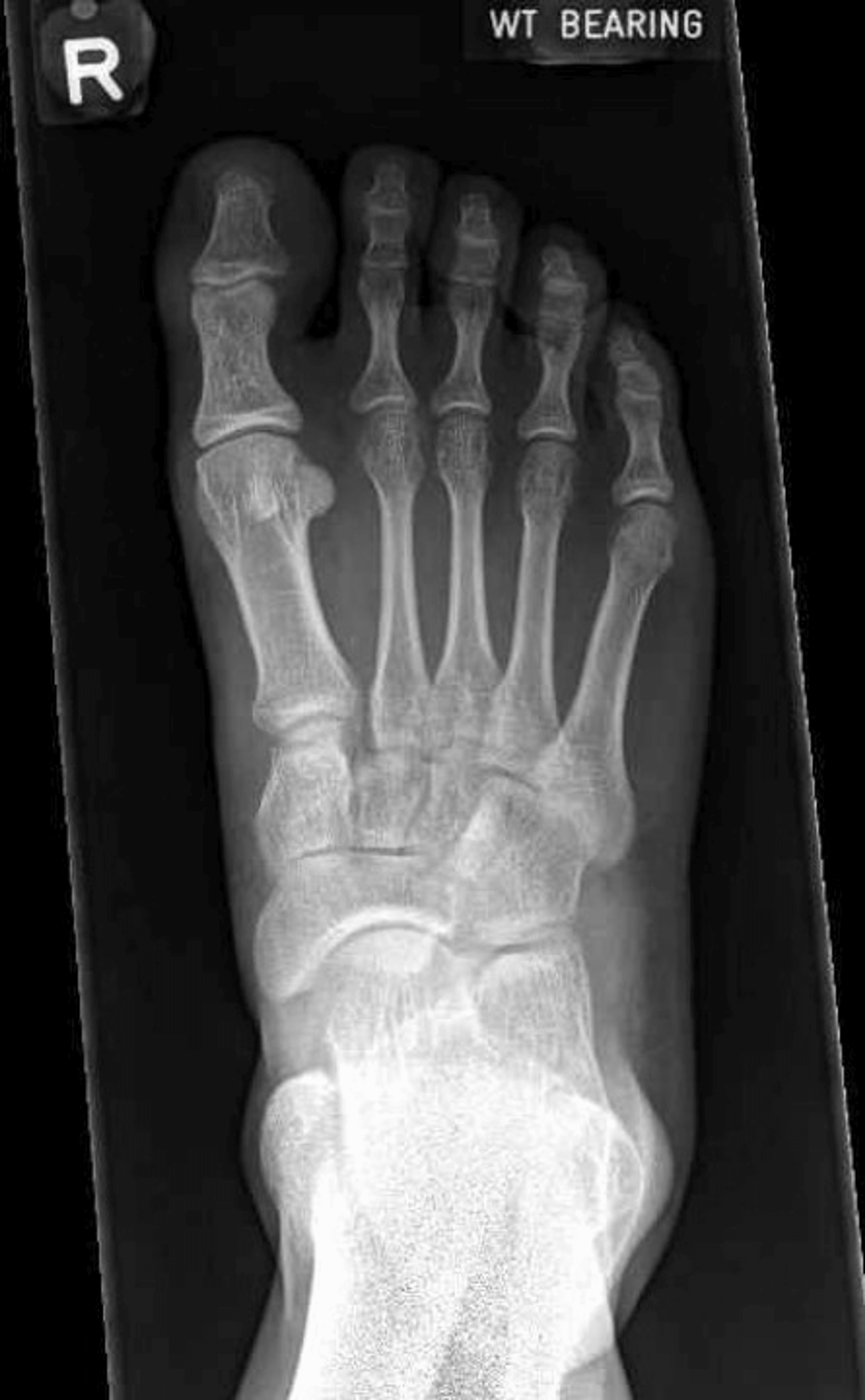 Cureus Suspensory Device Fixation of Lisfranc Injuries in a Southeast