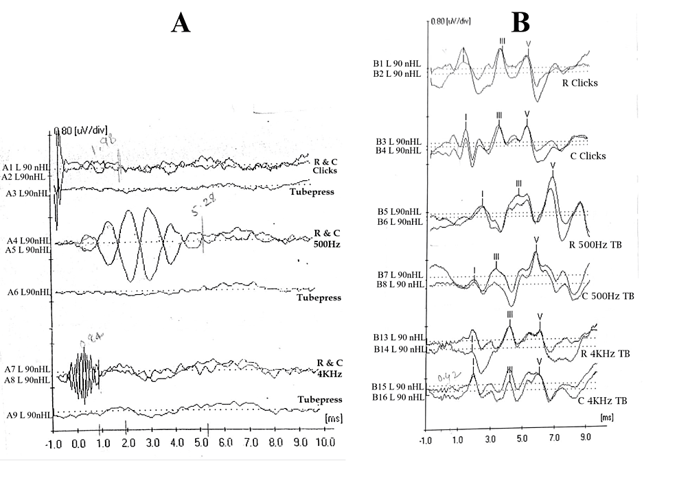 Cureus, Duration of Cochlear Microphonics in Click and Toneburst-Evoked  Auditory Brainstem Response in Individuals With Auditory Neuropathy  Spectrum Disorder and Normal Hearing