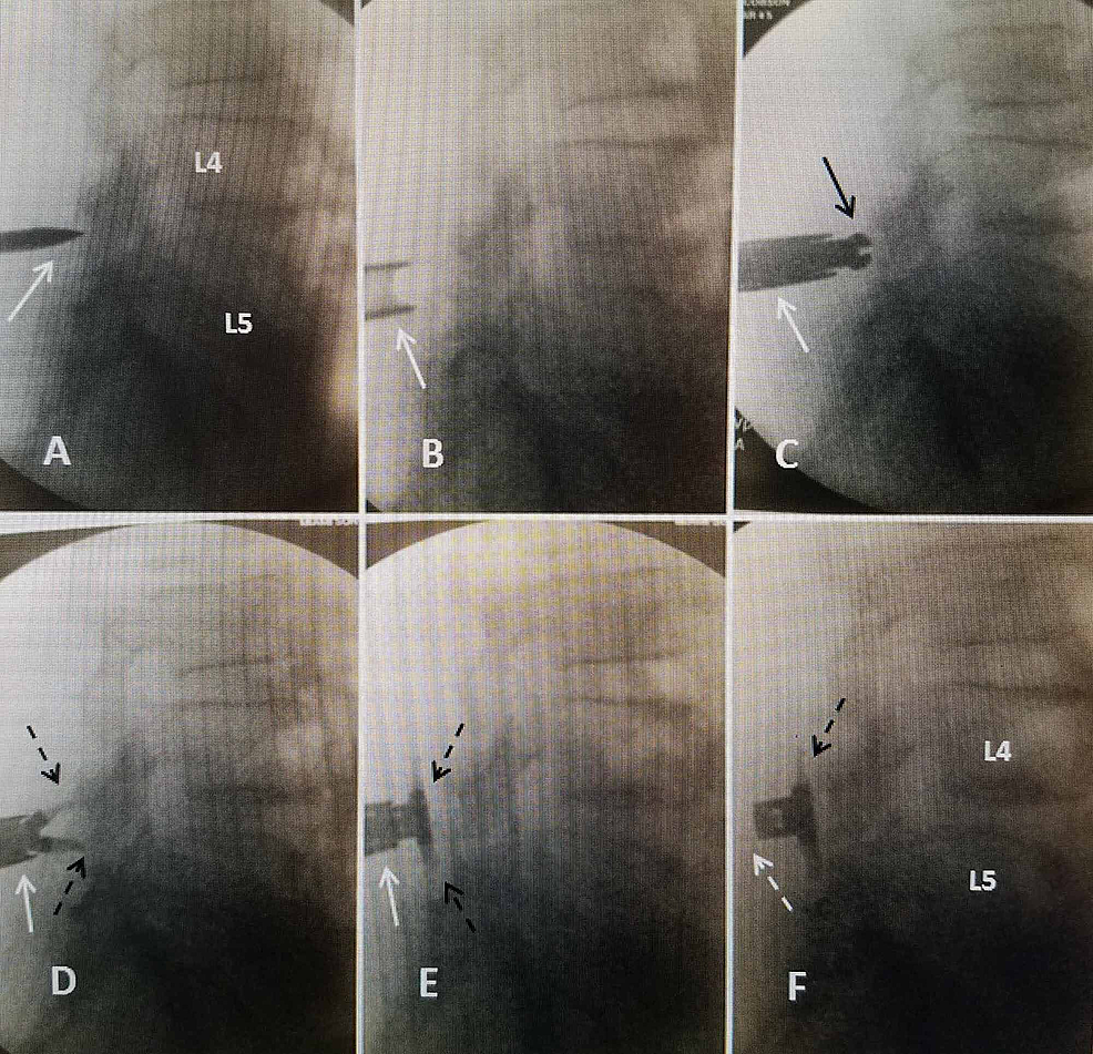 The Use of Vertiflex® Interspinous Spacer Device in Patients With