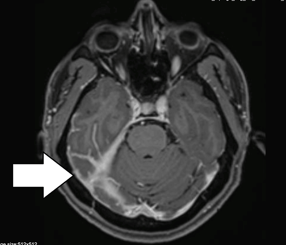 Cureus | A Rare Diagnosis of Aseptic Hypertrophic Pachymeningitis: A ...