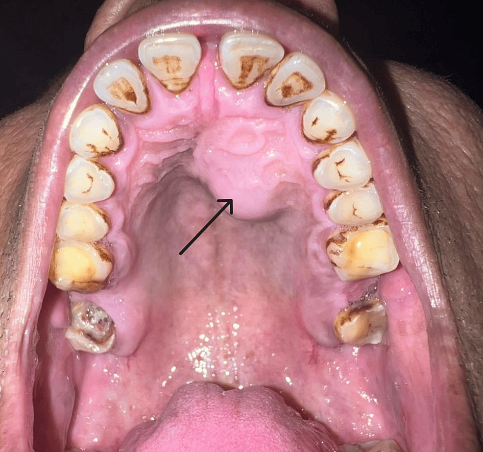 Cureus Radicular Cyst A Cystic Lesion Involving the Hard Palate
